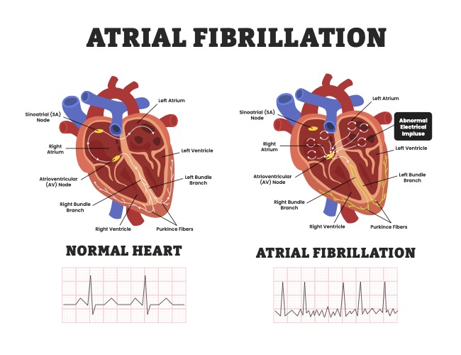 atrial fibrillation diagram