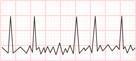 afib ekg rhythm